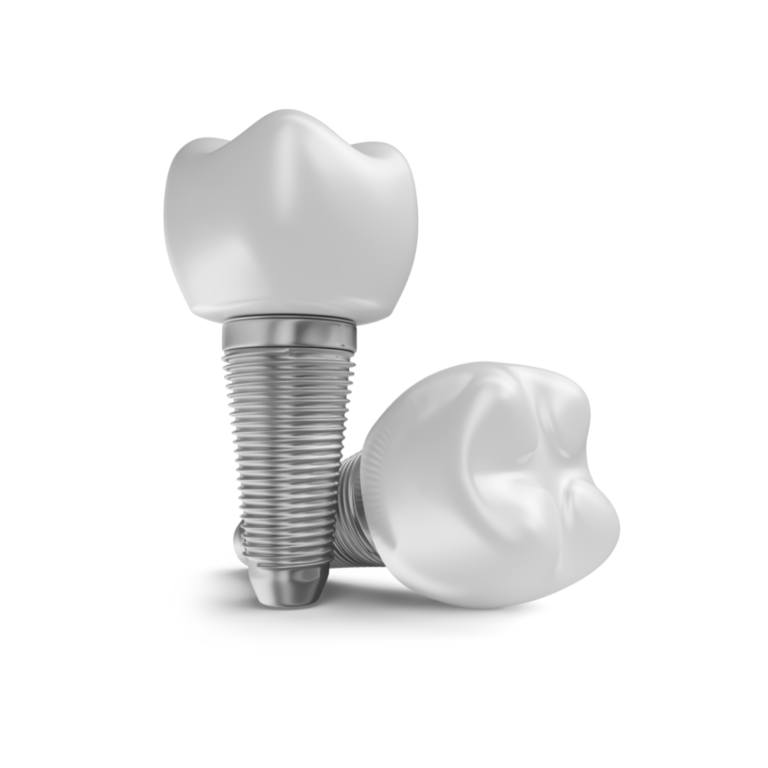 Dental Implants: Why We Need It?